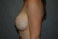 Breast Implant Exchange