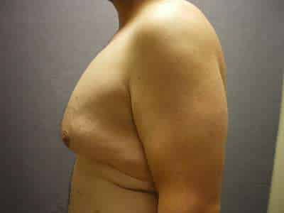 Male Belt Lipectomy