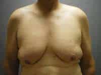Male Belt Lipectomy
