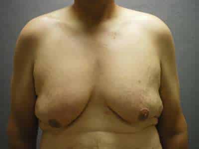 Male Belt Lipectomy