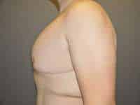 Male Belt Lipectomy
