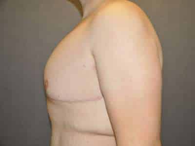 Male Belt Lipectomy