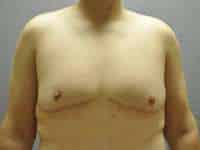 Male Belt Lipectomy