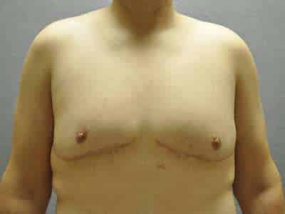 Male Belt Lipectomy