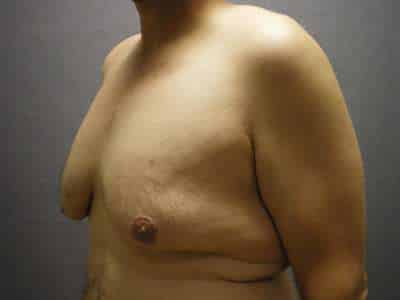 Male Belt Lipectomy