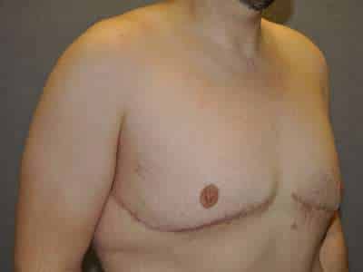 Male Belt Lipectomy
