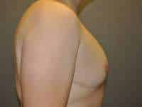 Male Belt Lipectomy