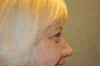 Eyelid Lift