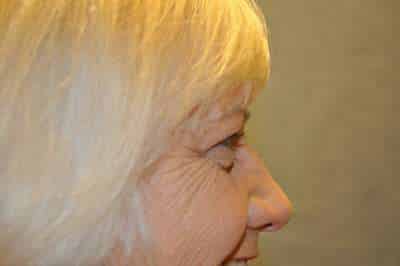 Eyelid Lift