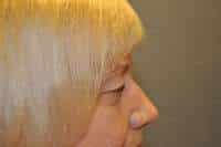 Eyelid Lift