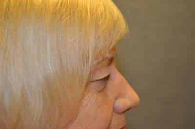 Eyelid Lift
