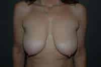 Breast Lift
