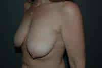 Breast Lift