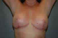 Breast Implant Removal