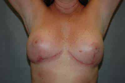 Breast Implant Removal