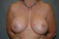 Breast Implant Removal