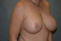 Breast Implant Removal