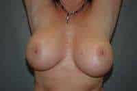 Breast Implant Removal