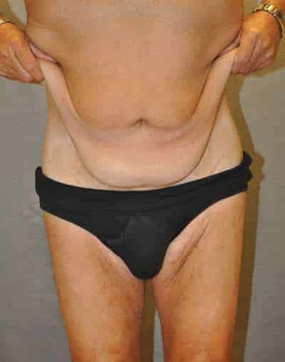 Abdominoplasty