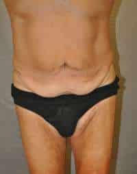 Abdominoplasty