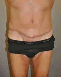 Abdominoplasty