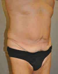 Abdominoplasty