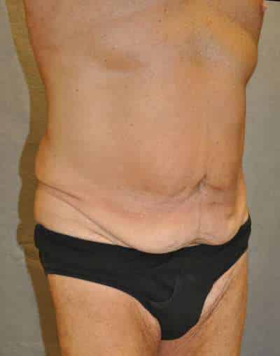 Abdominoplasty