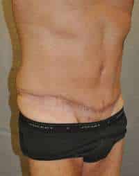 Abdominoplasty