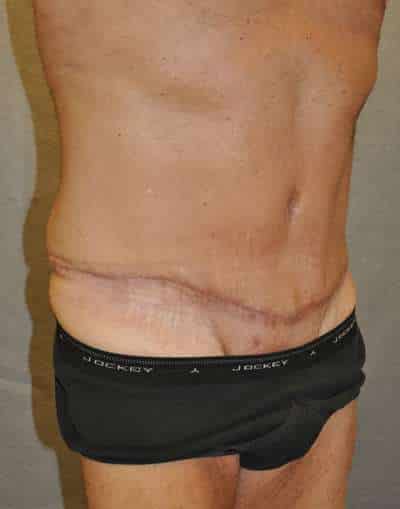 Abdominoplasty