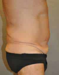 Abdominoplasty