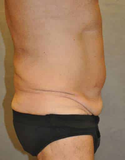 Abdominoplasty