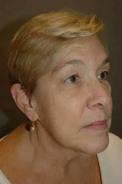 Eyelid Lift