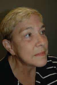 Eyelid Lift