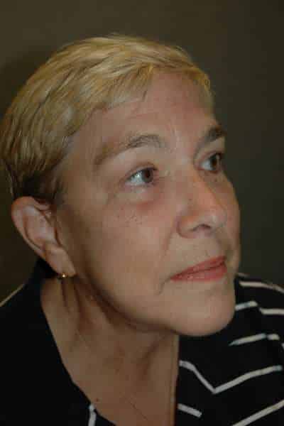 Eyelid Lift