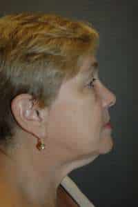 Eyelid Lift