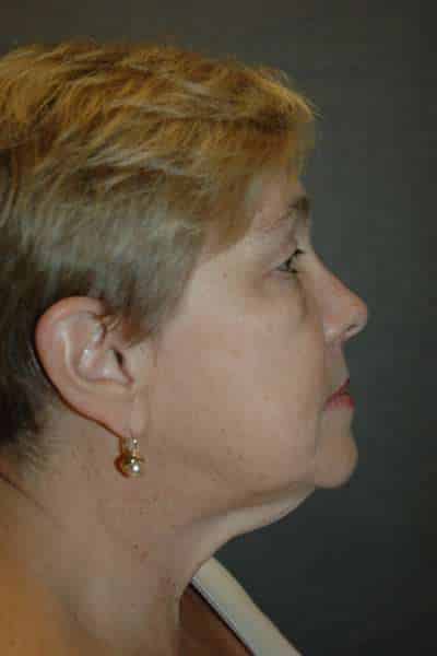 Eyelid Lift