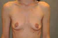 Breast Augmentation