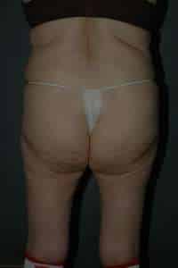 Liposuction