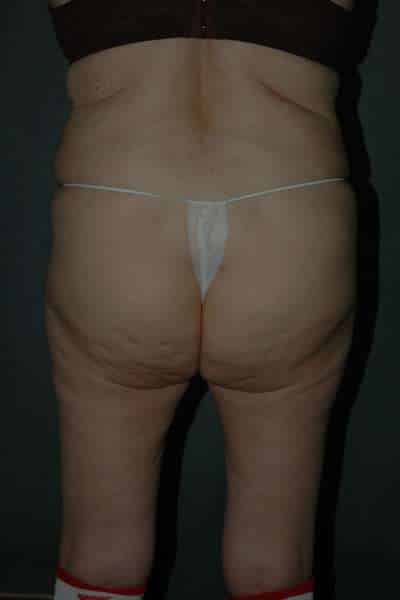Liposuction