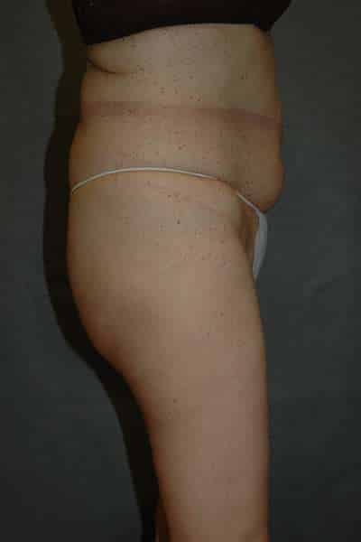 Liposuction