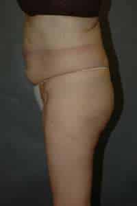 Liposuction