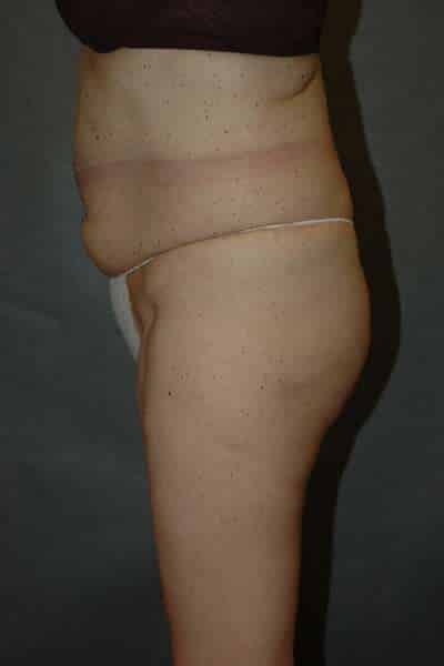 Liposuction