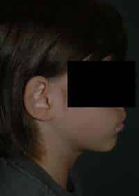 Otoplasty