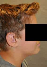 Otoplasty