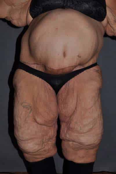 Panniculectomy