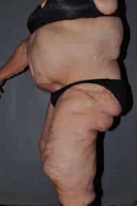 Panniculectomy