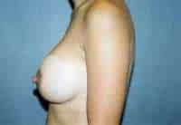 Breast Augmentation