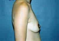 Breast Augmentation