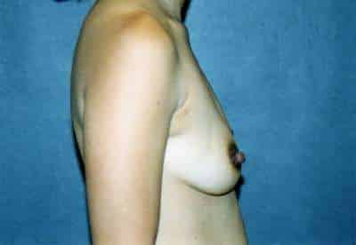 Breast Augmentation