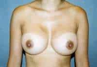 Breast Augmentation
